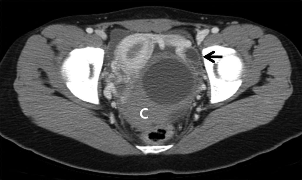 Fig. 4. Rupture of ovarian dermoid cyst in a 15-year-old girl who complained of lower abdominal pain with tenderness and rebound tenderness.