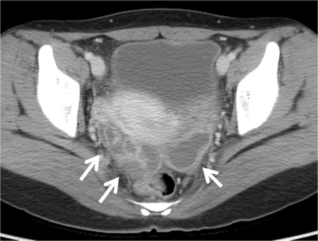 . Postcontrast sagittal image shows low attenuation mass (arrow) with irregular enhanced wall in uterine myometrium. 골반염사춘기이후에성적활동의증가로청소년기의여성에서골반염은골반통의한원인이된다 (1-3).