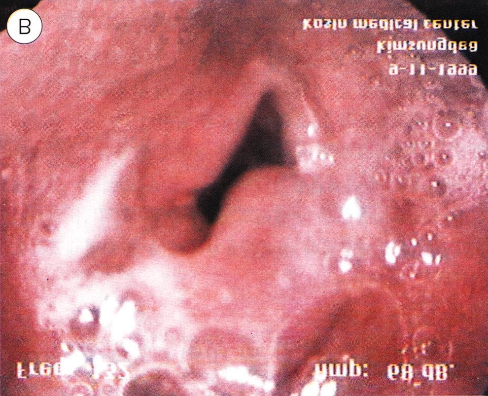 기관식도발성환자에 대한 영상학적 음향학적 고찰 Fig. 1. Stroboscopic images of the neoglottis during phonation. A Split anterior to posterior B Split right to left. Table 2. Vibratory patterns of the neoglottis Case No.