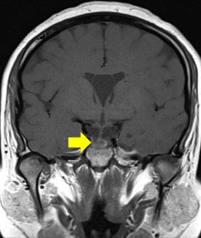 The CT scan obtained at admission day (A).