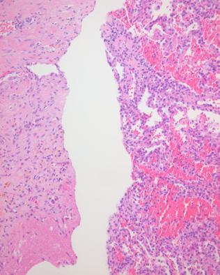 intra-alveolar hemorrhage (right fragment), and granulation tissue with hemosiderin-laden