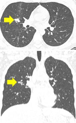 HRCT scan obtained 1 week after intracranial pressure control, shows evidence of the mass