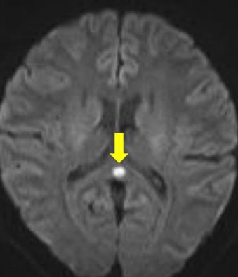 Note decrease in size of the mass (arrow) (C).