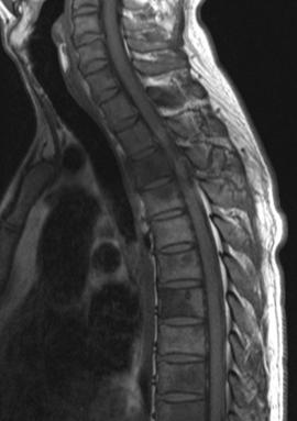 Sagittal T1- and T2-weighted image of the cervical spine shows intradural-extraspinal cord