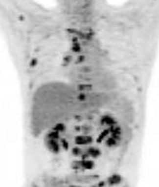 (G, H) A 43-year-old man had headache, nausea, vomiting, blurred vision, lower back pain, and