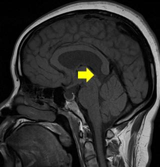 Sagittal T1-weighted image of the cervical spine shows multiple vertebral bone metastases (G).