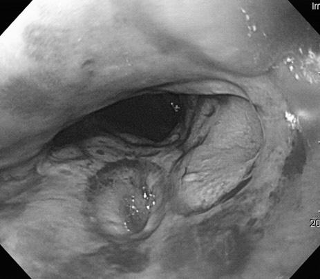 Stricture Complications of GERD Reflux