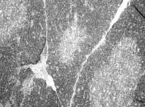 Ultimobranchial cysts (1309) lined by flattened squamous epithelium and distended with keratin and cellular debris (arrows). H & E. 100. 렴 (interstitial pneumonia) 이 3 례 (Fig.