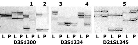 Tuberculosis and Respiratory Diseases Vol. 58. No. 4, Apr. 2005 는다거나 (LOH), 띠의길이가달라서백혈구에서증폭산물의띠위치보다아래또는위에서관찰되는양상 (BS) 으로관찰되었다. 4. 통계분석연속변수는평균 ± 표준편차로표현하였다. 통계분석은 SPSS for Windows version 12.