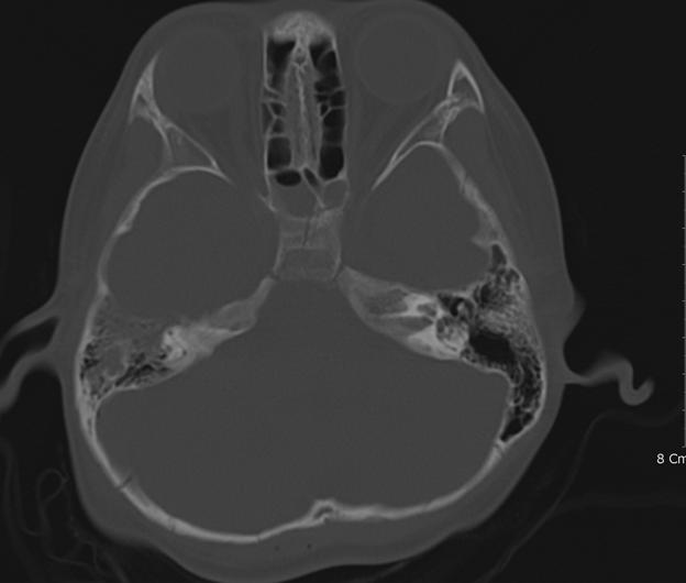 Primary Traumatic Brainstem Hematomas A B C D E F FIGURE 1. Radiological images of case 4. A: Acute small intracerebral hematoma on the left putamen.