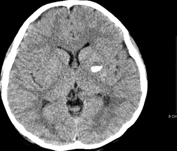 E: Suspicious high signal lesion in the corpus callosum in FLAIR image compatible with a diffuse axonal injury.
