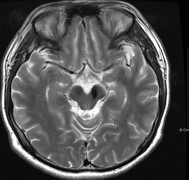 D: Acute hematoma in T2WI on the brain MRI without any evidence of underlying diseases.