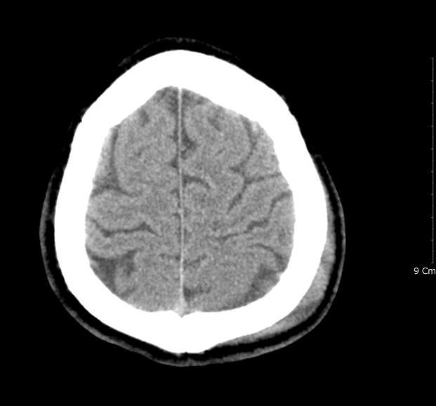 Tsai 등17)은 두부 태학적 개념의 진단이고, 외상성 혹은 자발성 여부는 병인 외상 CT 소견으로 일차성 뇌간출혈은 뇌간부 손상을 동반 적 개념일 것이다.