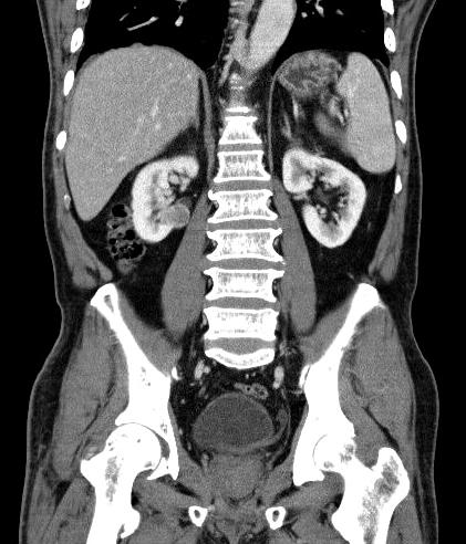 (C, D) Central tumor; the inner margin of the tumor approaches to the renal sinus fat. 3.