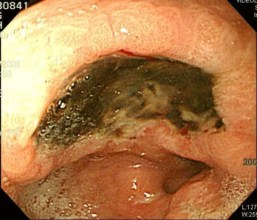 gastric ulcer; 10~40%