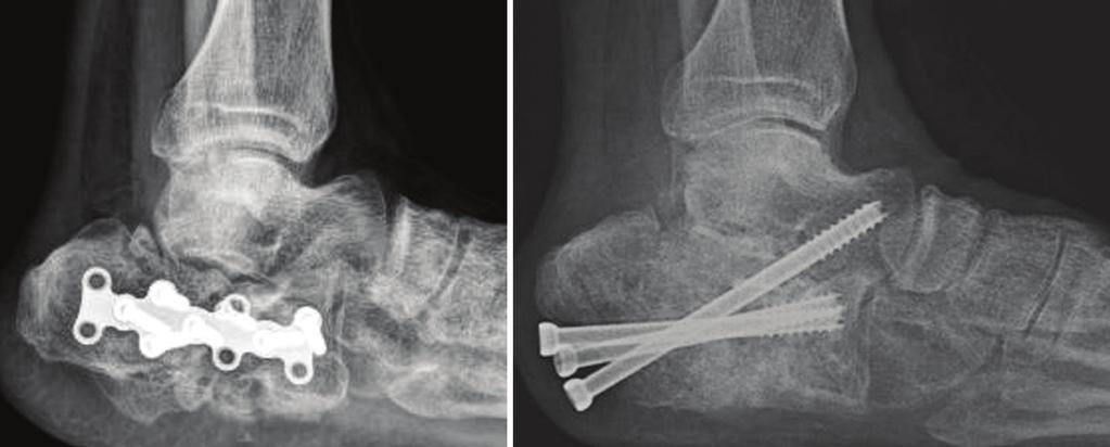 종골의관절내골절후발생한불유합의수술적치료 A B Fi g ur e 2. (A) Lateral radiograph of a 48-year-old man with nonunion of intra-articular fracture of calcaneus shows nonunion of the calcaneus.