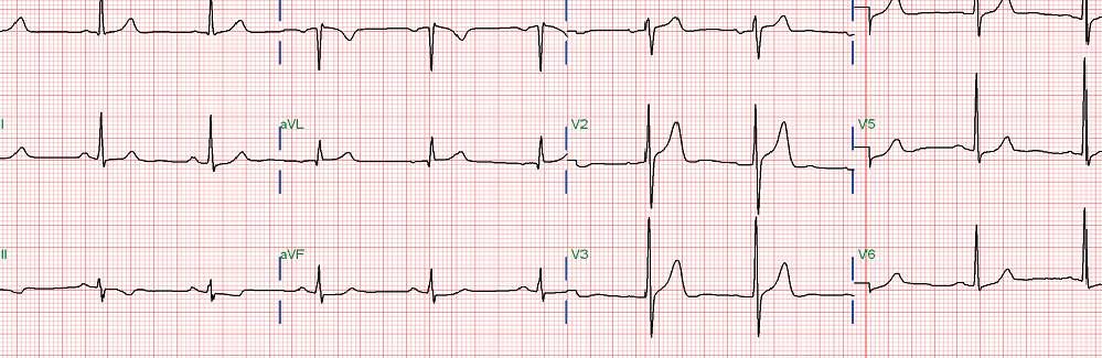 EKG is Non-diagnostic in Most of Cases The resting EKG is normal in 50% of stable angina,