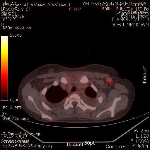 53 PL, anti-smith Ab: negative, dsdna IgG: 10 IU/mL( 정상치 : 0 25), dsdna IgM : 17 IU/mL( 정상치 : <20), 항핵항체 (antinuclear antibody, ANA) 와 ANCA 는음성이었다.