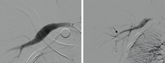 - Ho-Jung An, et al: Arterial thoracic outlet syndrome with upper extremity thrombus and cerebral infarction - A B Figure 1.