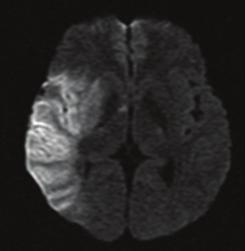 - 대한내과학회지 : 제 75 권제 5 호통권제 579 호 2008 - Figure 4. Brain MRI shows high signal density in right middle cerebral artery territory in diffusion weighted image.