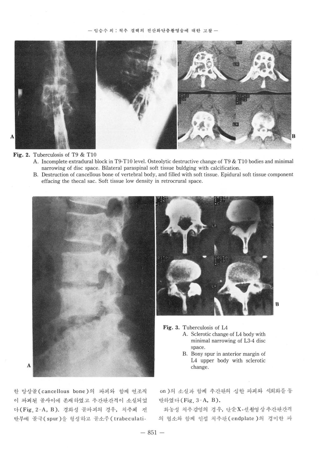 임숭수외 척추결핵의전산화단층촬영슐에대한고철 A B Fig. 2. Tuberculosis of T9 & TIO A. Incomplete extradural block in T9-TIO level. Osteolytic destructive change of T9 & TIO bodies and minimal narrowing of disc space.