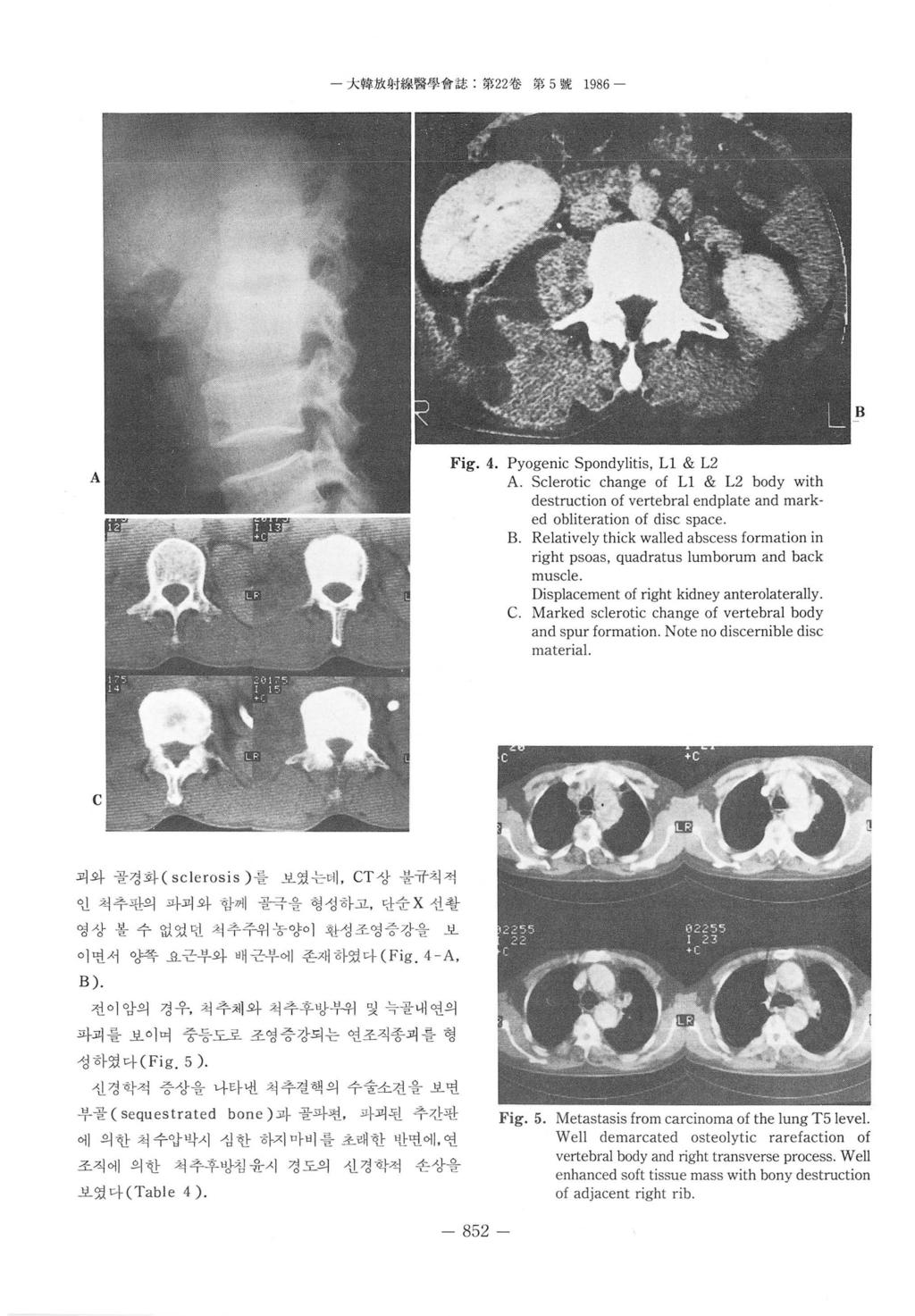 - 大합放射 M! 활용짱會짧쩌 '; 22 썰第 5 lj1jf. 1986 - A Fig. 4. Pyogenic Spondylitis, L1 & L2 A. Sclerotic change of L1 & L2 body with destruction of vertebral endplate and marked obliteration of disc space. B.