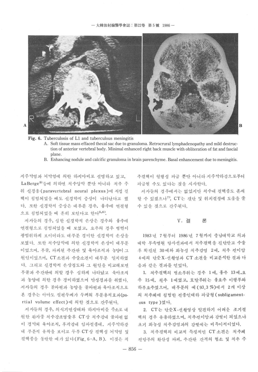 - 大함 11< 射級뽑쩔會誌 第 22 卷第 5 ~ 1986 A B Fig. 6. Tuberculosis of L1 and tuberculous meningitis A. Soft tissue mass effaced thecal sac due to granuloma.