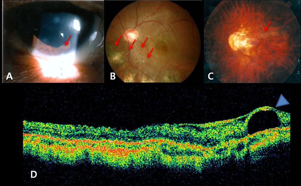 Fig. 1. A. Anterior segment Photo shows multiple PFCL bubble in inferior anterior chamber.(red arrow) B.