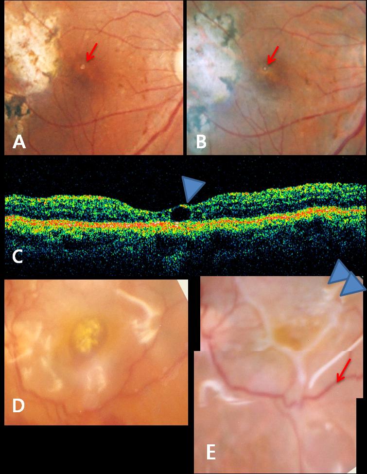 Complications of heavy liquid during PPV Fig 2. A. Retinography shows round reflex at macular due to subfoveal PFCL and atrophic change around posterior pole due to laser treatment. B.