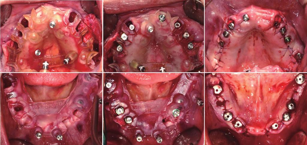 Full mouth rehabilitation of a patient using monolithic zirconia and dental /M system: a case report E F Fig. 6. Implant fixture placement.