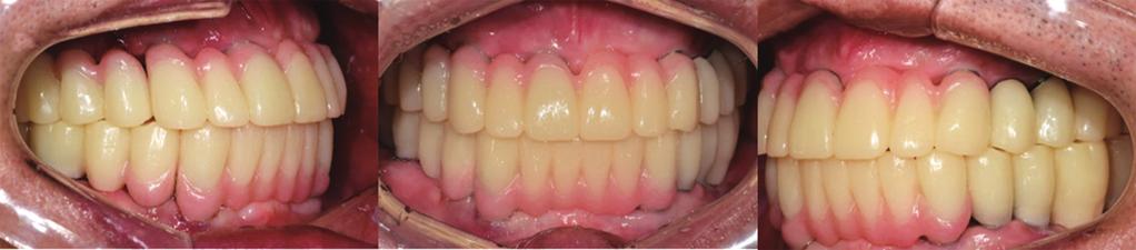 Full mouth rehabilitation of a patient using monolithic zirconia and dental /M system: a case report Fig. 12. Provisional prosthesis. () Right lateral view, () Frontal view, () Left lateral view.
