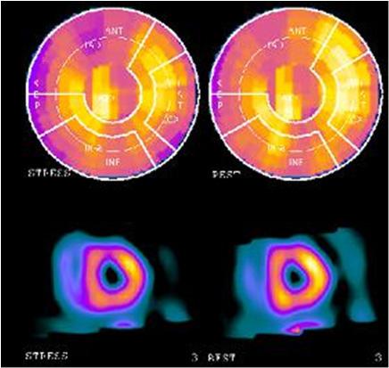 - 조미영외 6 인. Inverted Takotsubo cardiomyopathy - Figure 3.