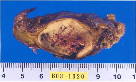 () Microscopic findings of the left adrenal mass confirmed a diagnosis of pheochromocytoma. 프린 1.