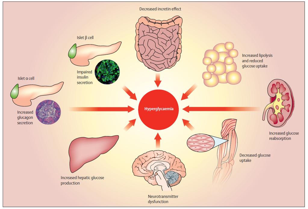 Typical pathophysiological features of hyperglycemic in