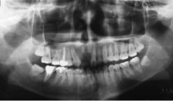 치아결손부에자가치아이식술을시행한치험례 25 Fig. 1.