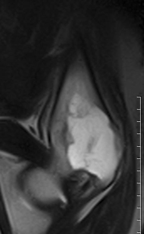 (B) The initial axial T2 weighted MRIs shows a subtle cortical disruption with soft tissue involvement.