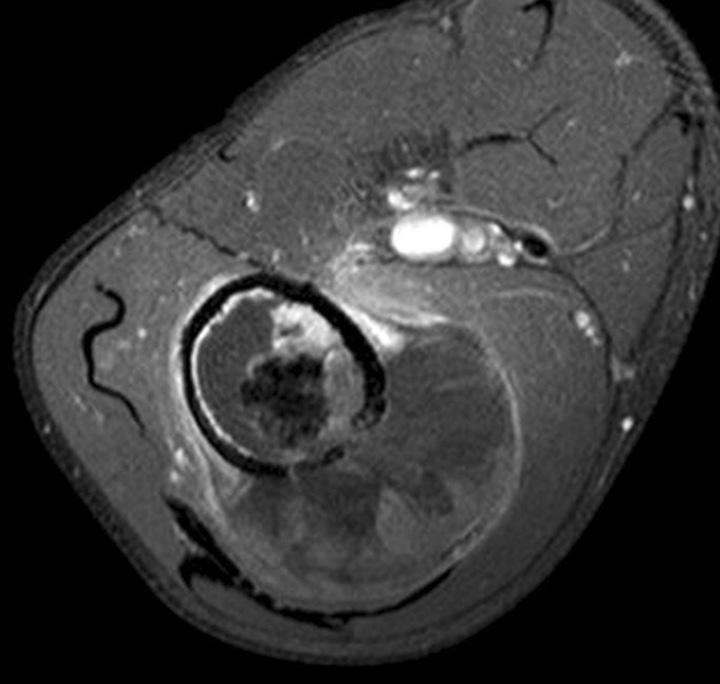 169 Dedifferentiated Chondrosarcoma A B C E D F Figure 3. A 60-year-old man with right thigh mass that developed 2 months ago (case 8).