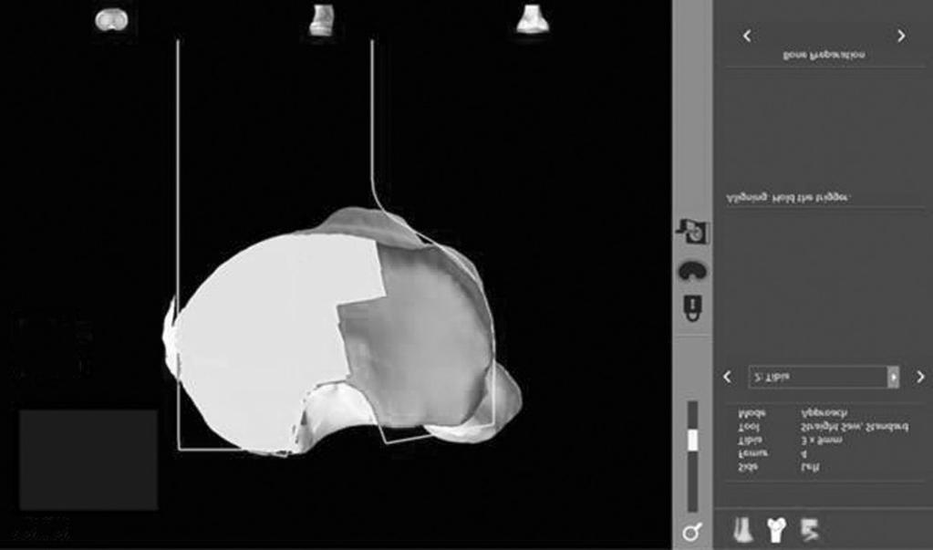 resection Varus External P.slope Figure 1. A 3-dimensional model is loaded into the robotic system software and used to develop a preoperative plan for robotic total knee arthroplasty.