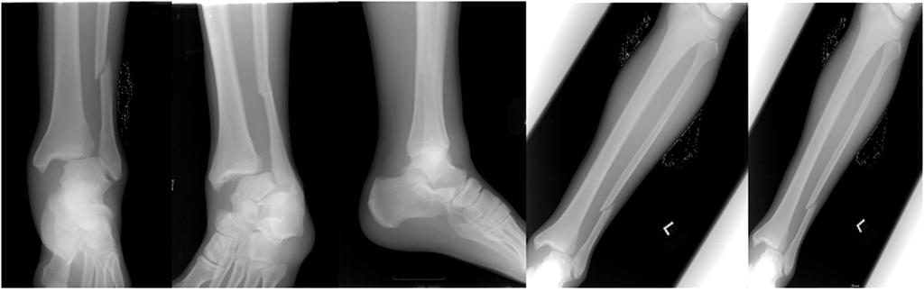 곽희철 권용욱 Figure 3. Ankle AP, Mortise, Lateral, Tibia AP and Lateral. Figure 4.