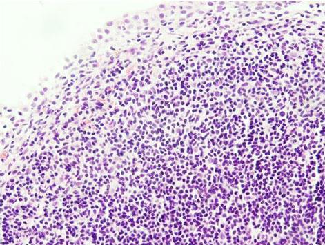 - Sunpyo Lee, et al. Primary MALT lymphoma of urinary bladder - A B Figure 2.