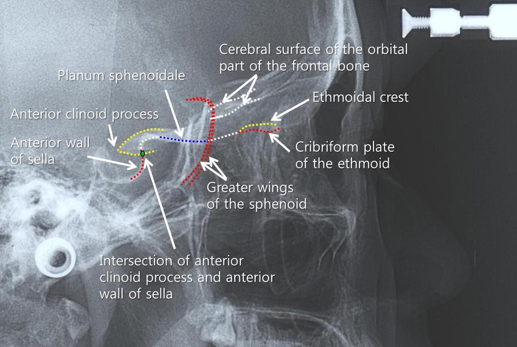 sella turcica의 anterior wall과 ethmoid bone의 cribriform plate입니다.