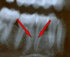 치근이근심혹은원심으로기울어져인접치의치근과접촉할경우 (Figure 45), 2점을부여합니다.