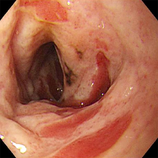 mo F, D, V, AD, H EC Multiple perforations Surgery AD: abdominal distension, AP: abdominal pain, C/S: cesarean section, D: diarrhea, DB: duodenal bulb, DC: descending