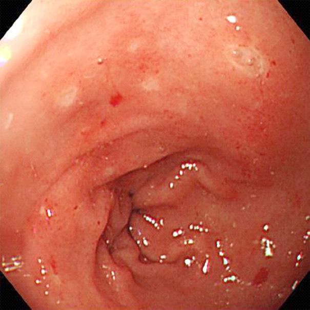 SC: sigmoid colon, V: vomiting. Fig. 1.