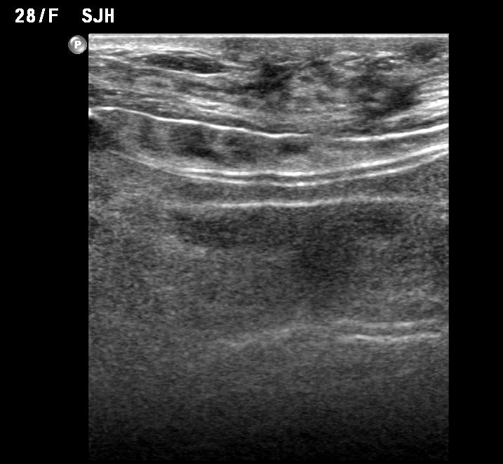 98 J Korean Surg Soc. Vol. 80, No. 2 Fig. 1. Ultrasonography showed discontinuity of the implant membrane and multiple parallel echogenic lines within the implant interior (stepladder sign).