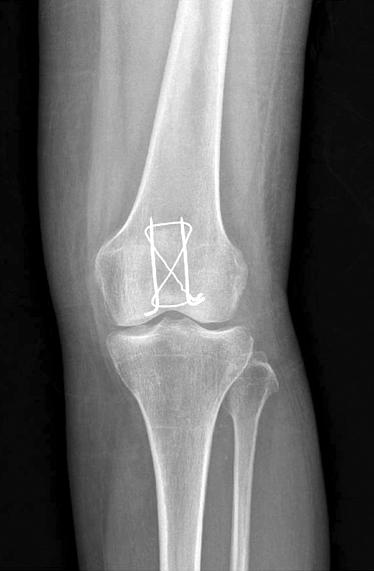 42-year-old woman, showing a displaced patella fracture. Fig. 4.