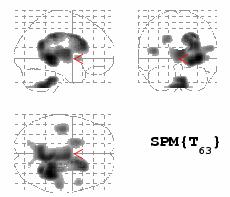 Kyung Won Park, et al. Differences of Tc-99m HMPAO SPECT Imaging in the Early Stage of Subcortical Vascular Dementia Compared with Alzheimer's Disease Table 4.