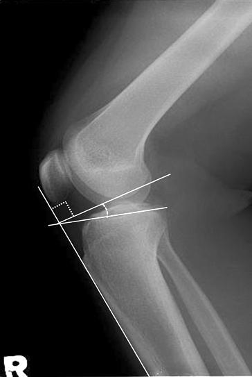 210 리를측정하였다 (Fig. 1) 22). 또한환자개개인의키에따른대퇴과간절흔폭의차이를교정하기위해대퇴과간절흔폭및높이의비를측정하여비교하였다. 후방경골경사각은 Bae 등 4) 에의해기술된무릎의측면단순방사선영상에서경골근위부피질골의전연을이은선의수직선과경골내과고평부를이은선이이루는각으로정의하였다 (Fig. 2).