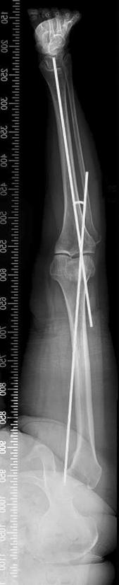 286 Seung Wan Lim, et al. A A x B C B Figure 3. Bilateral weight bearing anteroposterior whole lower limb x-ray in full extension for planning the Miniaci method.