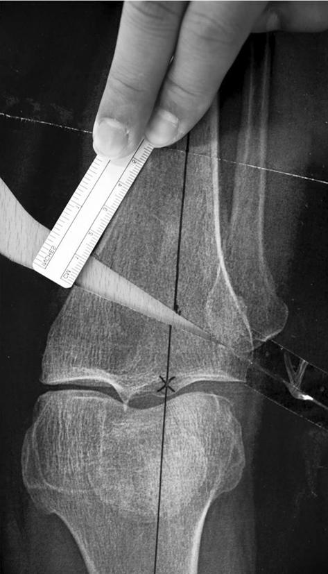 Line A is drawn from the center of the femoral head to 62.5% of the tibial width. Line B is drawn from the center of the tibiotalar joint to the 62.5% coordinate.